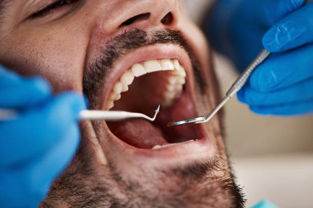 Best Emergency Dentist for Lost Fillings or Crowns in Kirbyville, TX